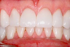 The image shows a close-up of a person's teeth with a focus on their front teeth, which appear to be in good condition and are well-maintained.